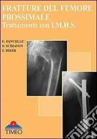Fratture del femore prossimale. Trattamento con I.M.H.S. Direttamente Dal Produttore